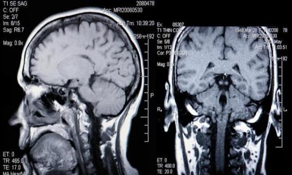 做一次脑CT对身体有哪些伤害?