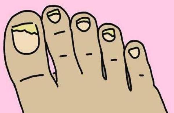 冬季灰指甲真没那么难治,这五个护理方法让你