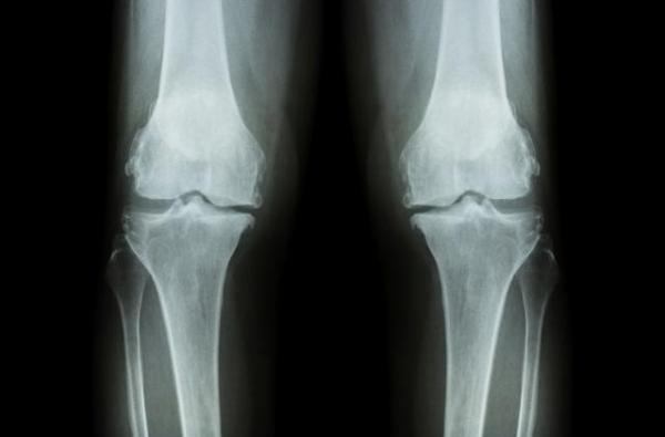 膝盖软骨磨损能不能食疗补一补?这几样食物了